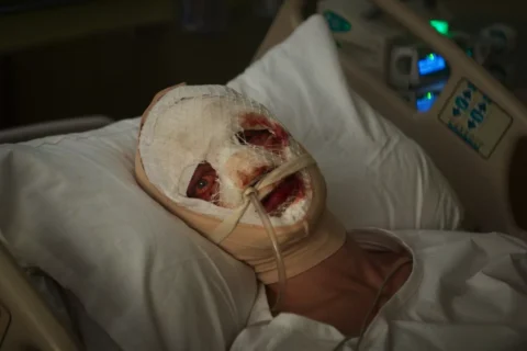 V nemocničnej posteli leží človek s ťažko obviazanou tvárou, pričom viditeľné sú iba oči. Scéna vyvoláva atmosféru zraniteľnosti a zotavenia.